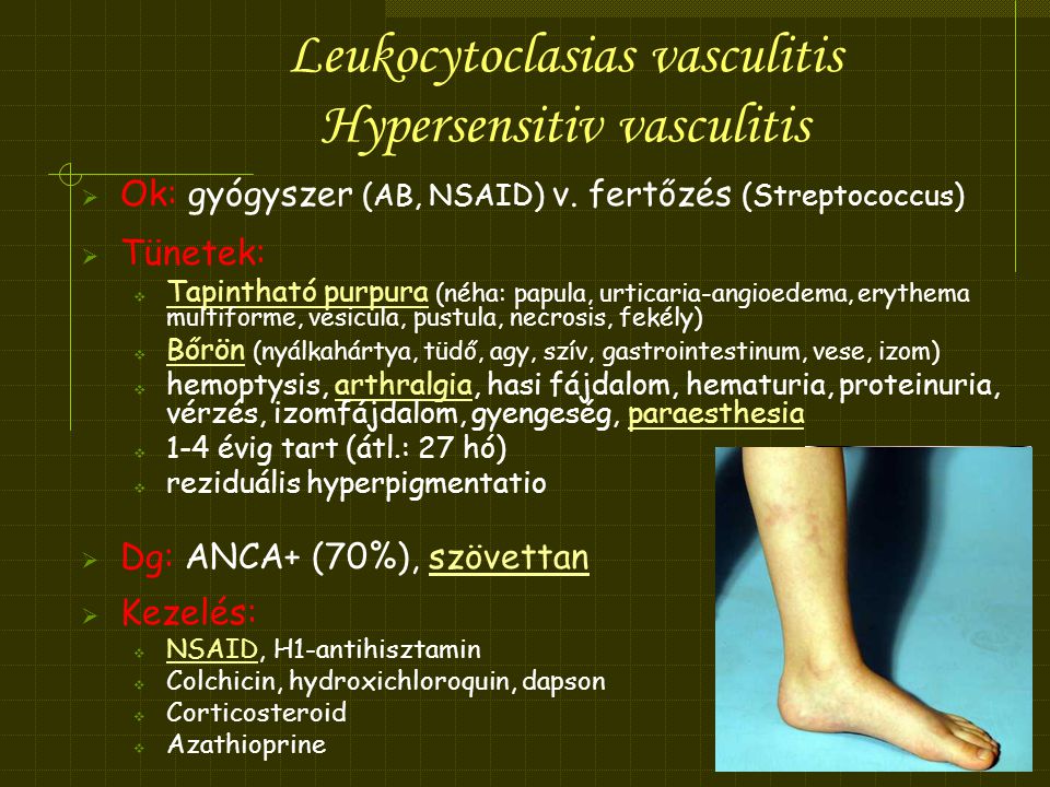 Az érgyulladás (vasculitis) típusai